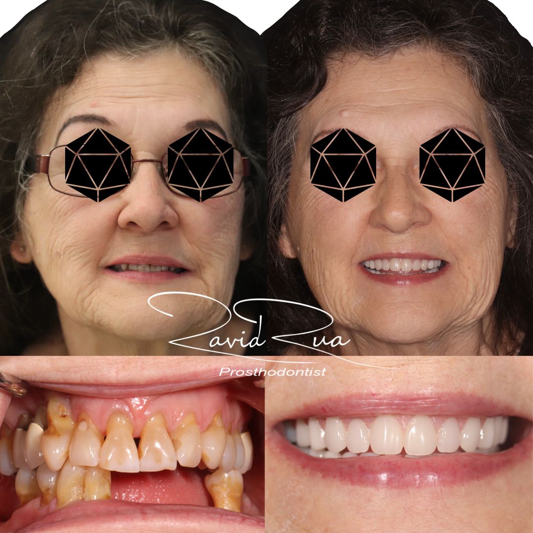 TC Cape Coral Case 13 Top denture and mandibular overdenture with a ti bar