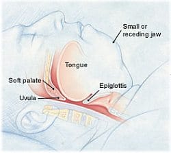 Obstructed Airway