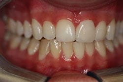 Veneers after
