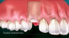 Bone Graft (Socket Preservation) 003