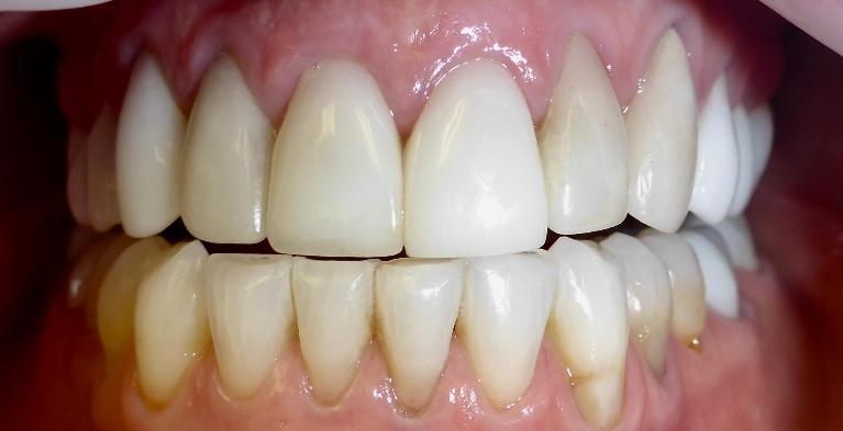 Grapevine Patient Unhappy With Previous Cosmetic Dentistry