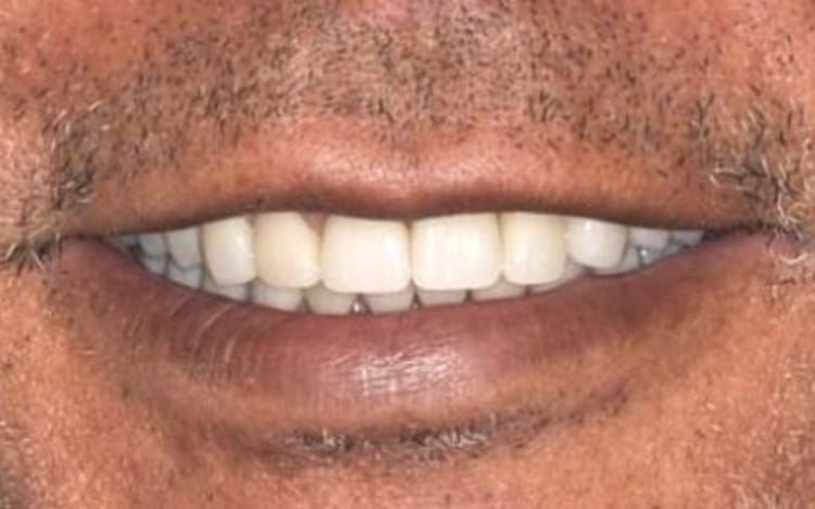 28. Patient GD (26 teeth + 2 implants - one implant is a front tooth!)_ 13 upper teeth with one front tooth porcelain implant crown and 13 lower porcelain crowns After