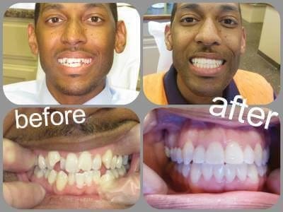Before and after