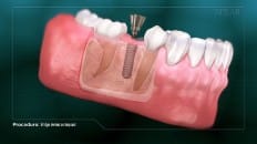 Bridge Versus An Implant 008