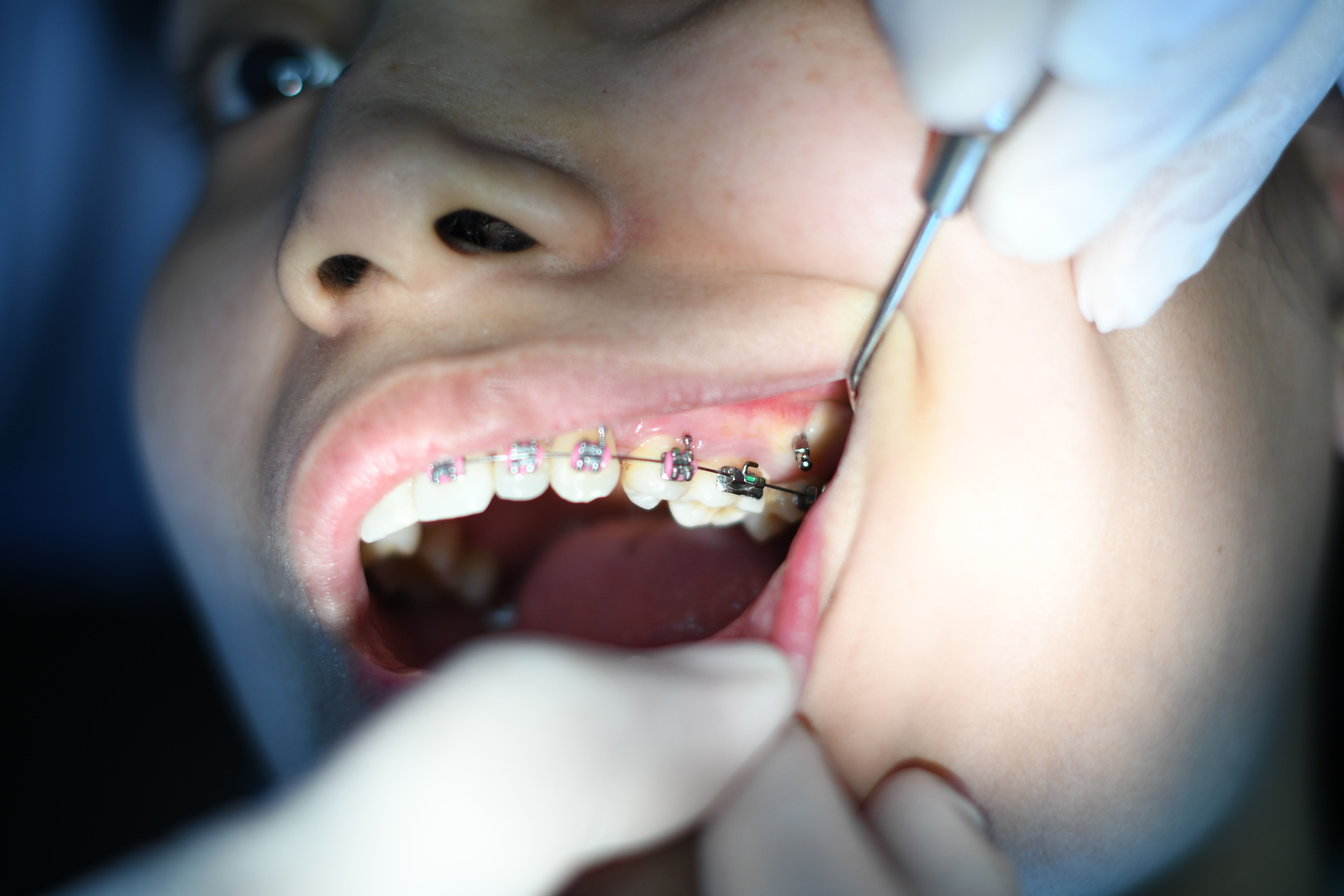 Invisible Aligners - Orthodontics