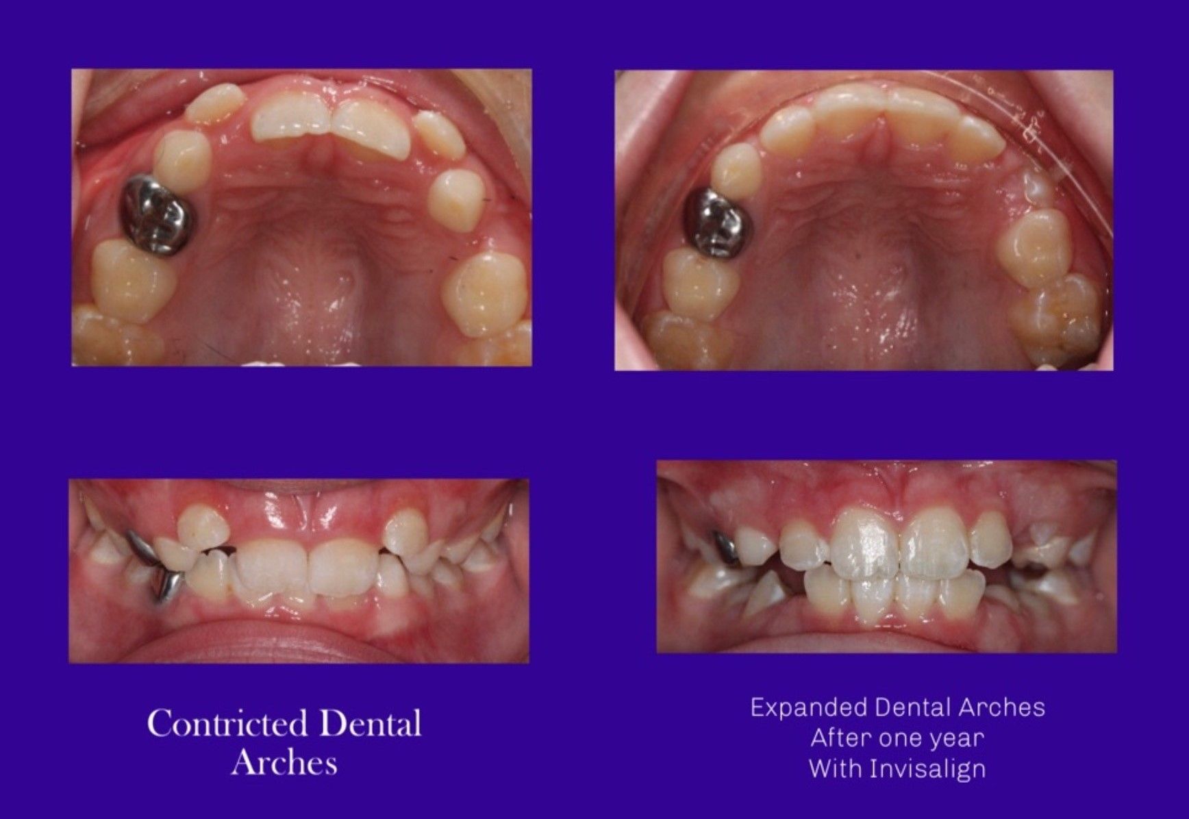 BSFortho Blog before and after with Invisalign