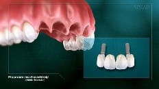 Implant-Supported Bridge 001