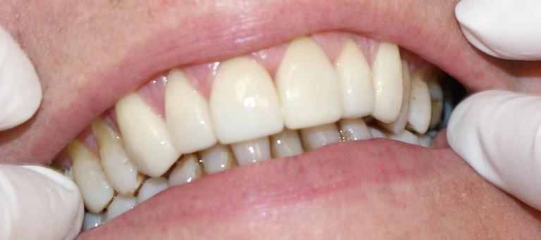 Grapevine After Smile Transformation 1