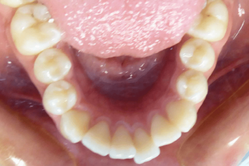 Bottom Jaw for Virtual Orthodontic Consultation