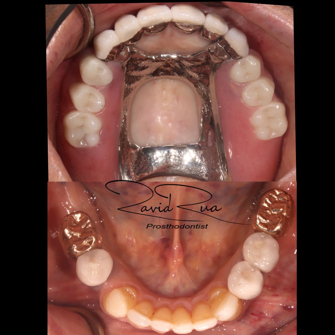 TC Cape Coral Case 19.3 Full mouth rehab, Implants , crowns and partial