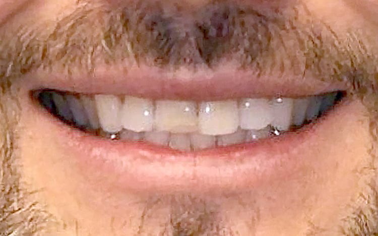 3. Patient MG (1 tooth)_ Single front tooth porcelain crown Before