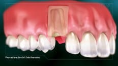 Bone Graft (Socket Preservation) 001