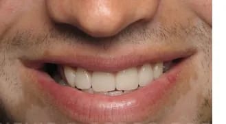 Veneers after