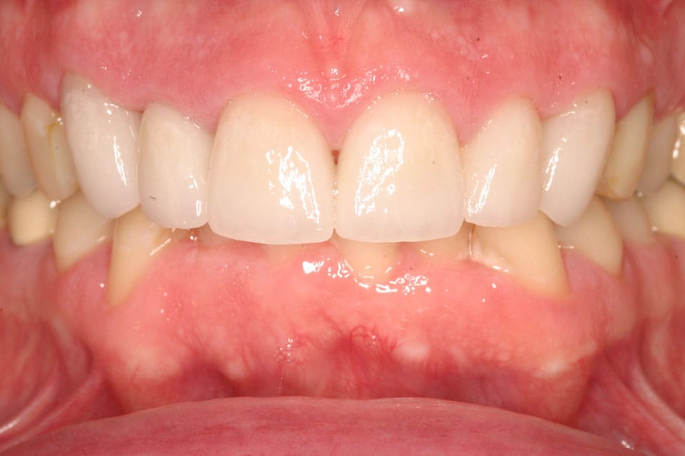 Rasner Smile gallery after 10