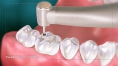 Filling Versus Crown 002 image