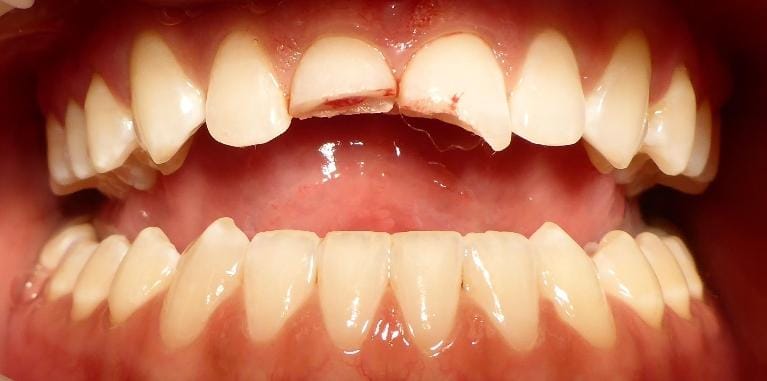Grapevine Before-Broken Teeth