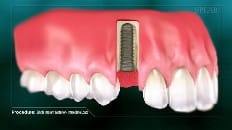 Single Implant (Anterior - Immediate Load) 003