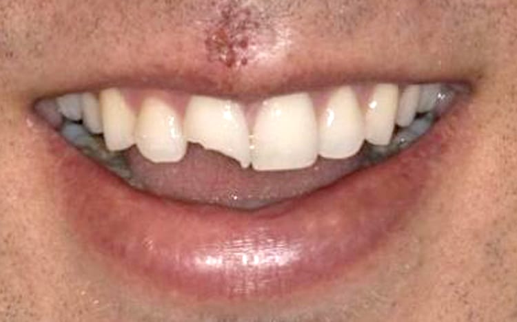 2. Patient JP (1 tooth)_ Single front tooth porcelain crown Before