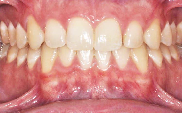 1. Patient EW (1 tooth) After