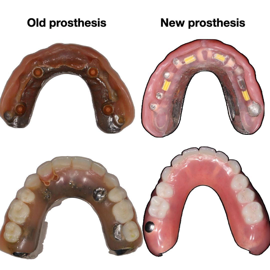 TC Cape Coral Case 9.1 Top and Bottom implants/bar supported overdentures