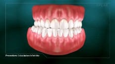Occlusal Appliance For Tooth Wear 001