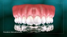 Whitening With Bleaching Tray 005