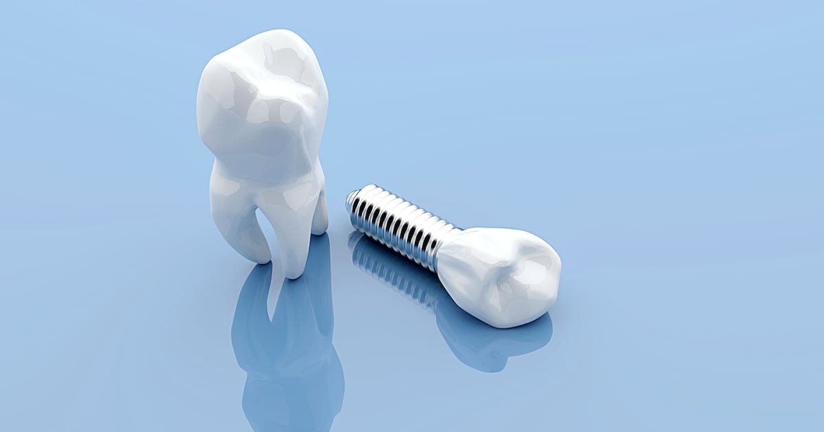 Are Tooth Implants Right for You?