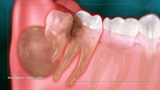 Impacted Third Molar 006