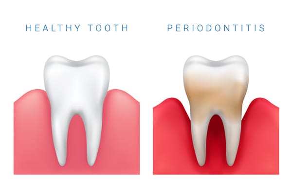 The Main Differences Between a Regular Cleaning and Periodontal Maintenance