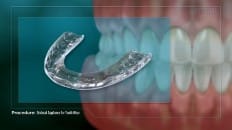 Occlusal Appliance For Tooth Wear 002