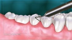 Gingival Probing And Pocket Depth 006