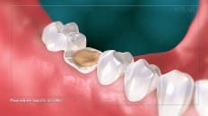 Surgical Extraction (Other) 001