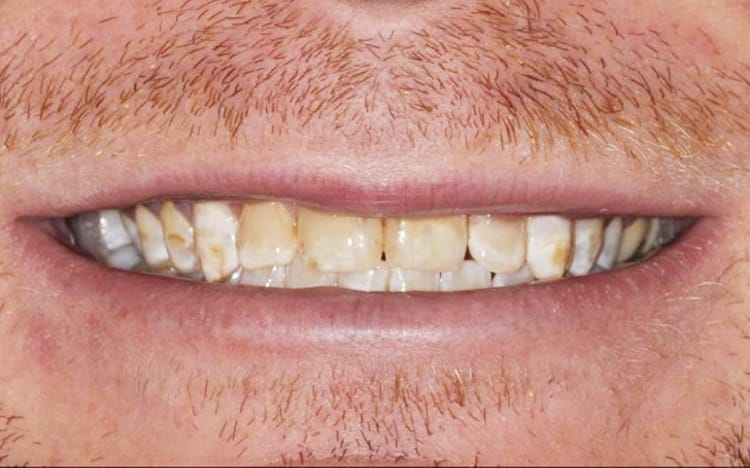 20. Patient AT (12 teeth)_ Porcelain crowns on upper 12 teeth Before