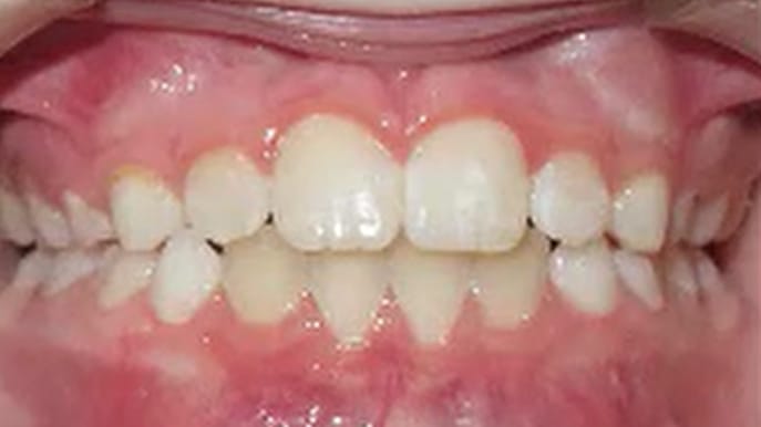 BF Ortho Smile Gallery After