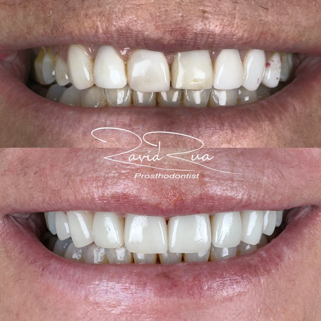 TC Cape Coral Case 11 Top veneers