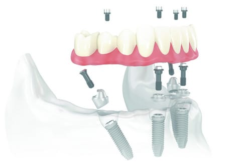 ALL-ON-4® PROCEDURE