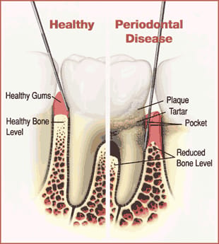 Periodontal Disease