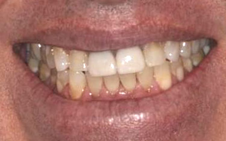 16. Patient KS (10 teeth)_ Porcelain crowns on upper 10 teeth Before