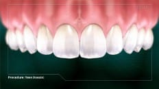 Veneers (Impression) 006