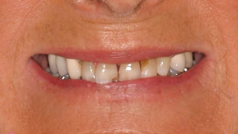 Anastasia Smile 05 before image