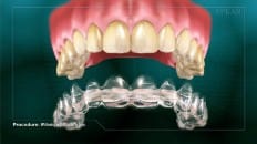 Whitening With Bleaching Tray 003