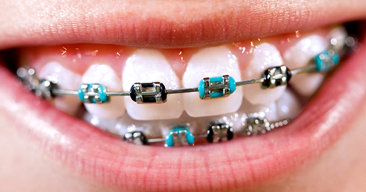 How to Care for Your Braces