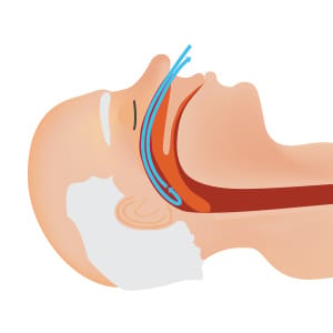 Sleep Apnea