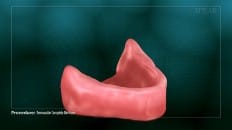 Removable Complete Dentures 001