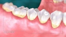 Gingivitis 002