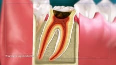 Surgical Extraction (Other) 007