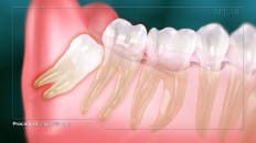 Impacted Third Molar 002