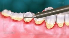 Gingivitis 003
