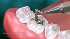 Composite Versus Amalgam Filling 002