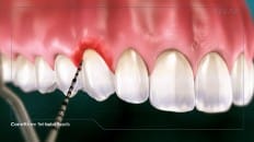Peri-Implant Mucositis 002